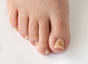 Toenail Fungus Toenail Fungus
