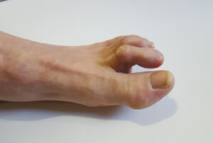 Hammer Toe