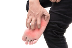 Foot Fungus Foot Fungus