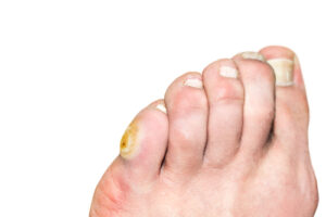 Foot Corn Foot Corn