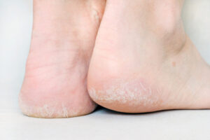 Callus Foot Treatment Callus Foot Treatment