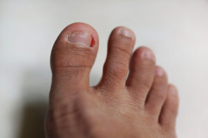 Ingrown Toenail Treatment